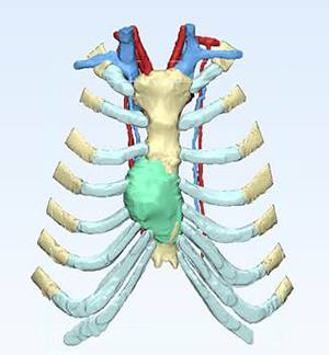 Using advanced 3D models to prepare for complex surgeries helps Mayo Clinic surgeons precisely tailor treatment to individual patients and their unique needs.