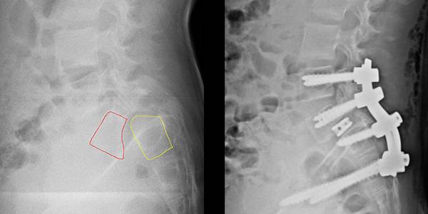 X-rays before and after surgery, showing the screws and rods to hold Albert’s spine in place for the fusion, as well as the improved alignment.