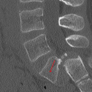 A CT scan of Albert’s low back. The arrow shows the L5 vertebra has slipped nearly off the S1 vertebra.